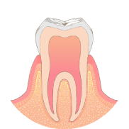 歯の表面にとても小さな虫歯ができます