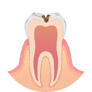 虫歯が神経に近くなり、冷たいものがしみます