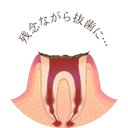 神経が死んでしまい、痛みを感じなくなります