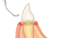 軽度歯周病（歯肉炎・歯周炎）