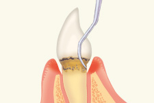 中度歯周病（歯周炎）