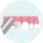 歯の表面をツルツルに仕上げ磨き